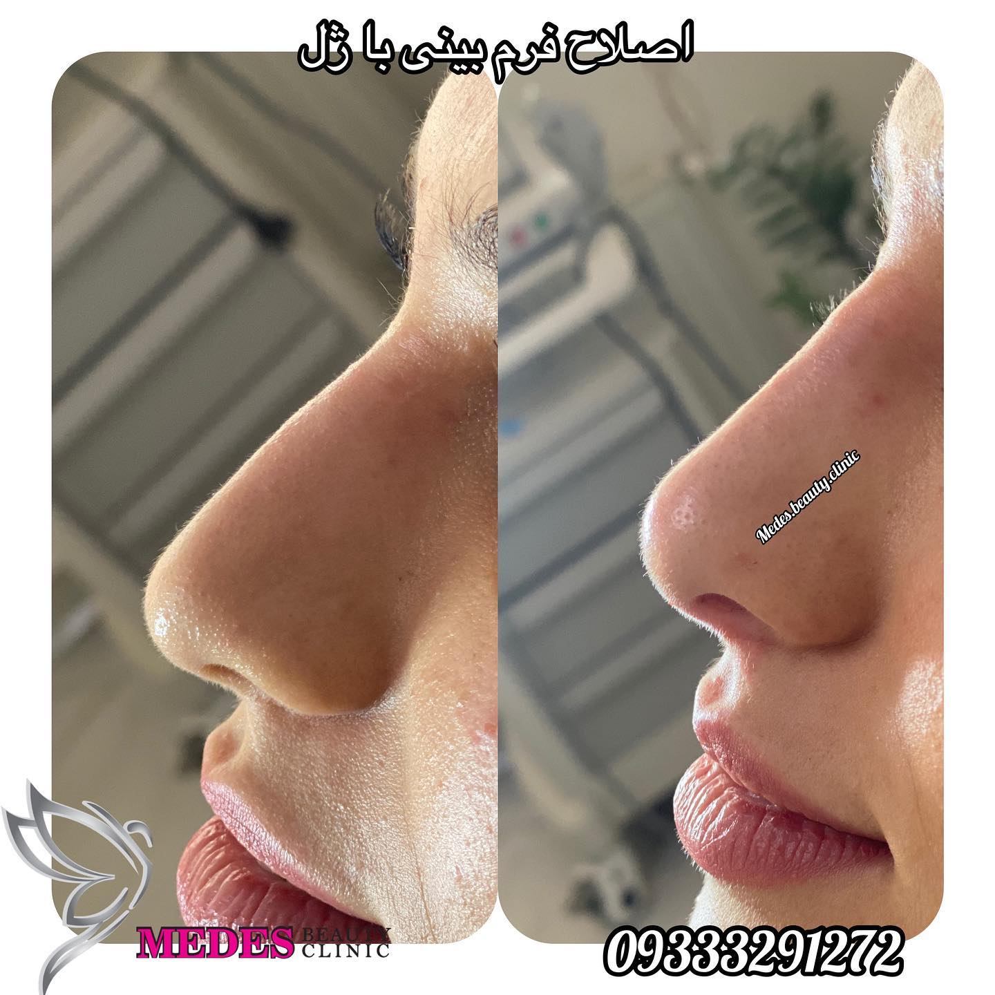 گالری اصلاح فرم بینی